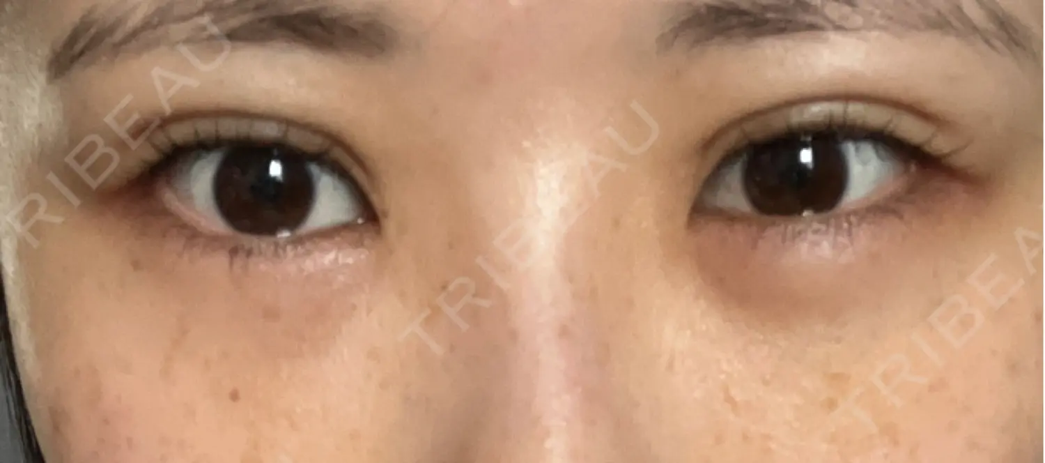 施術後の写真