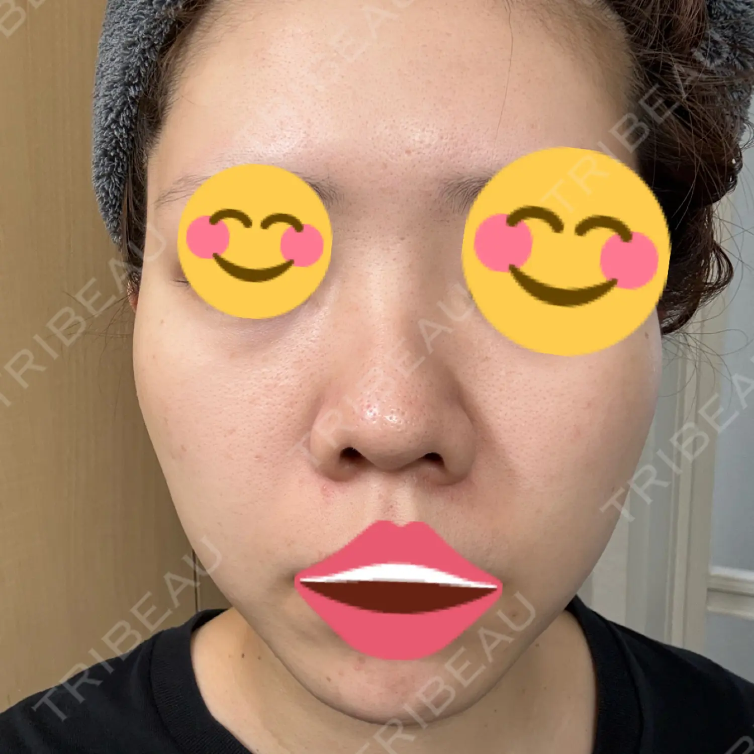 施術後の写真