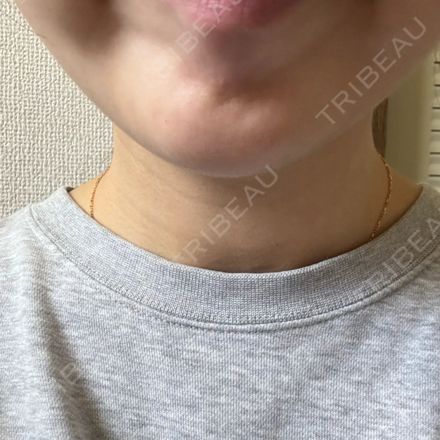 施術後の写真