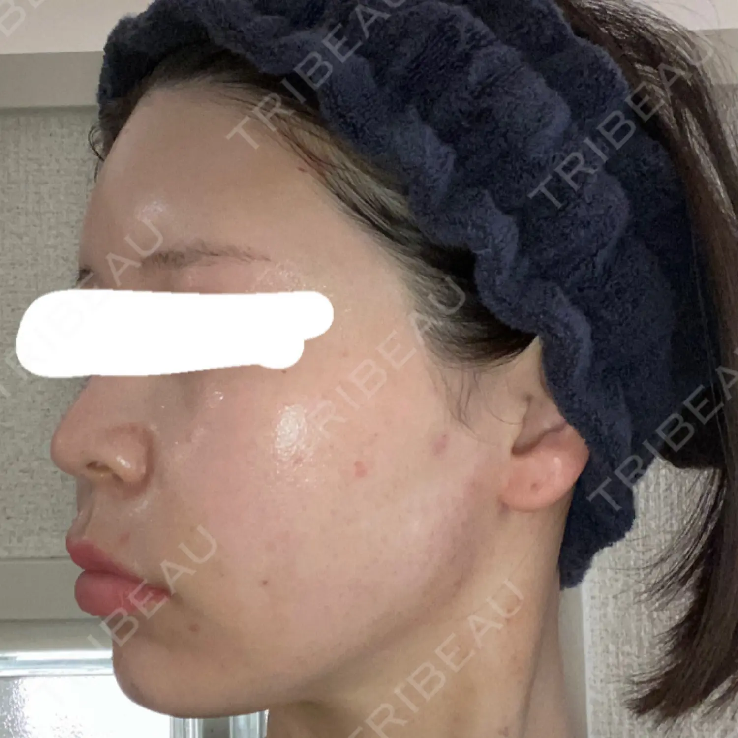 施術後の写真