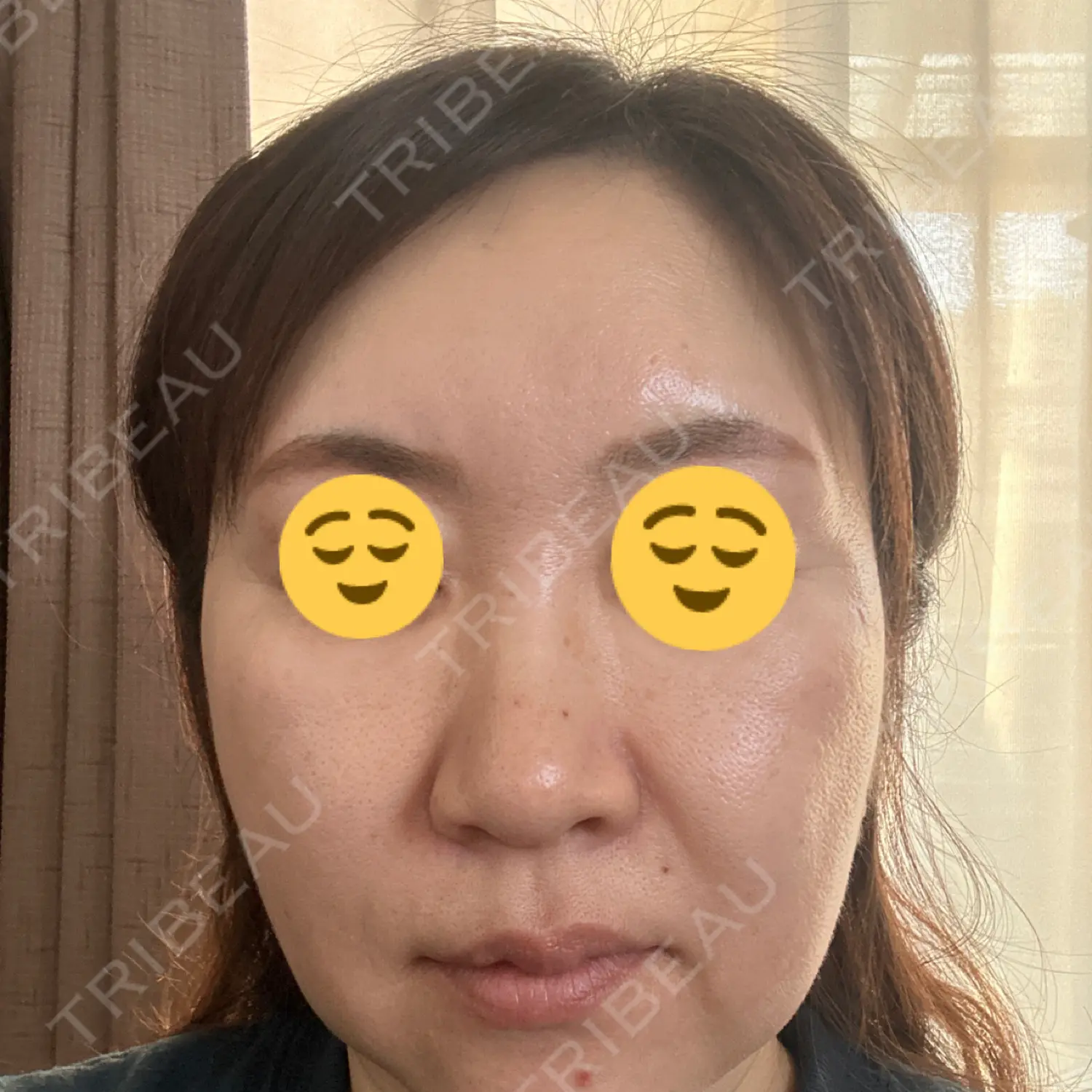 施術後の写真