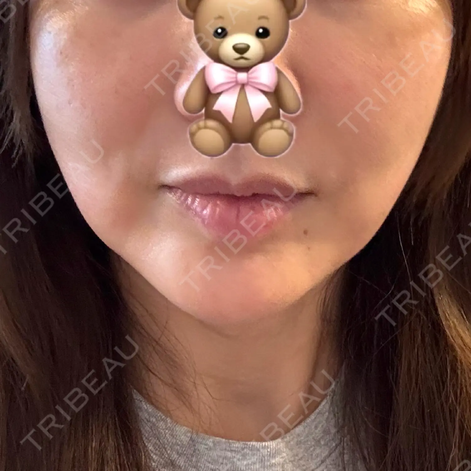 施術後の写真