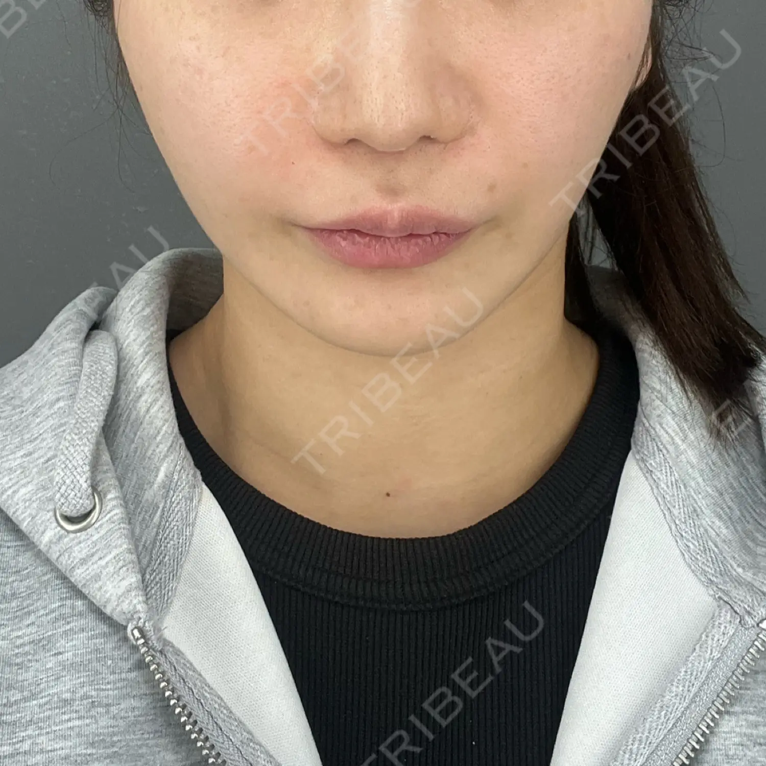 施術後の写真