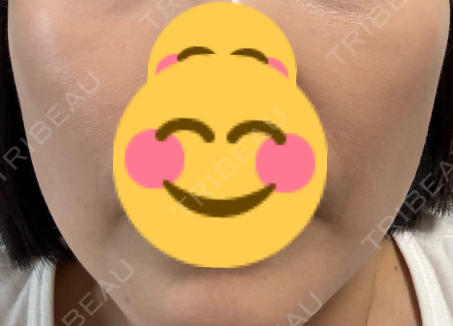 施術後の写真