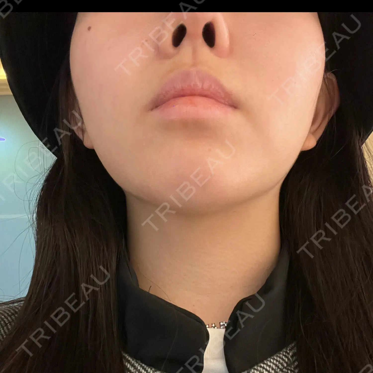 施術後の写真