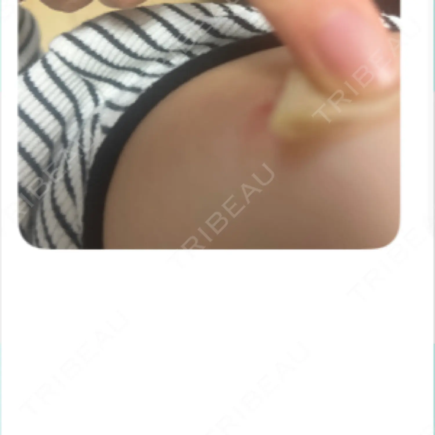 施術後の写真
