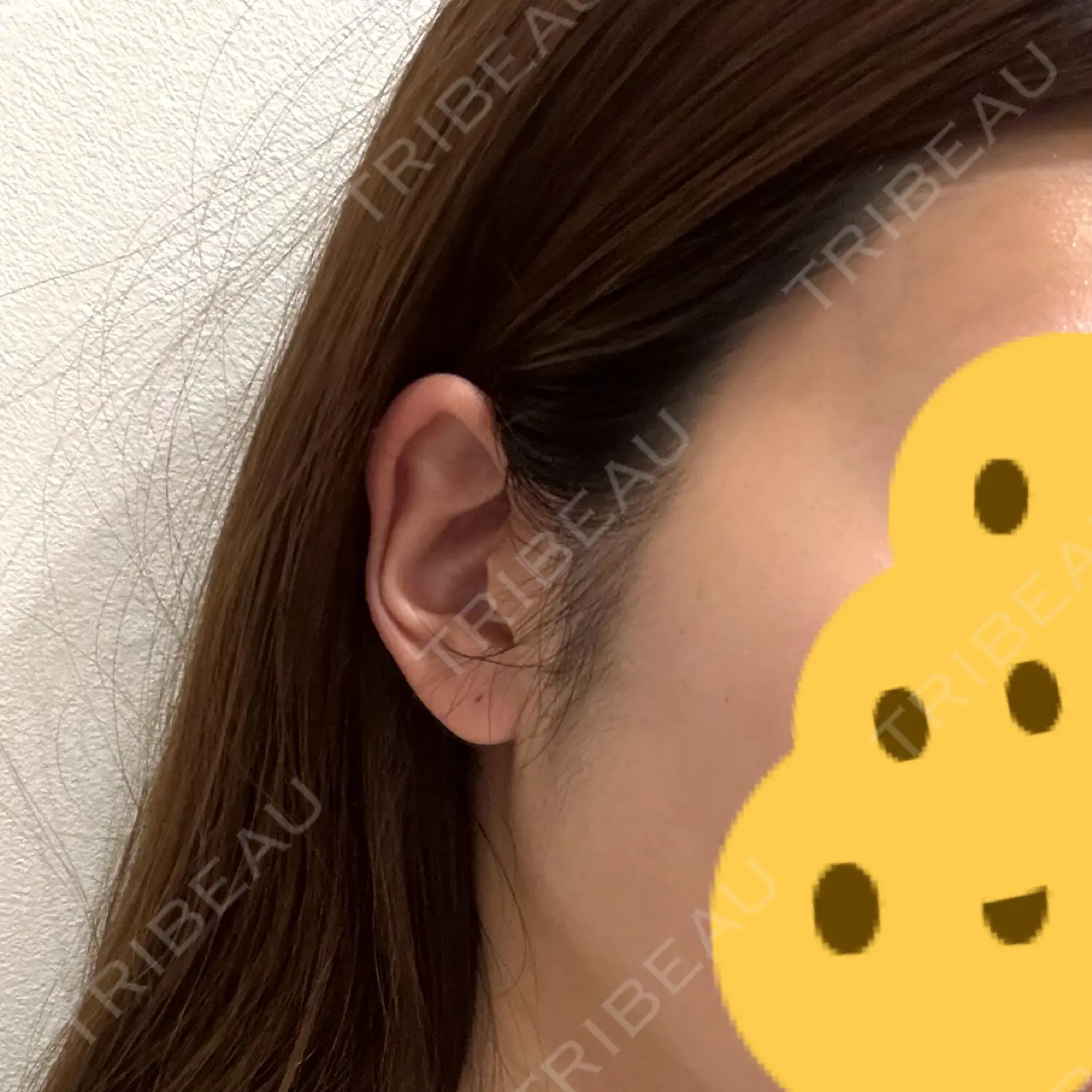 施術後の写真