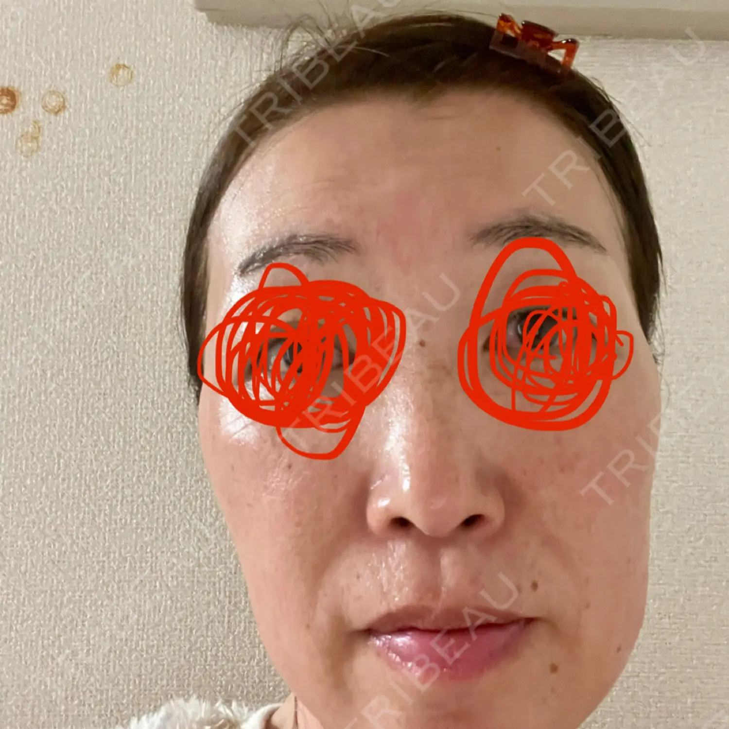 施術後の写真