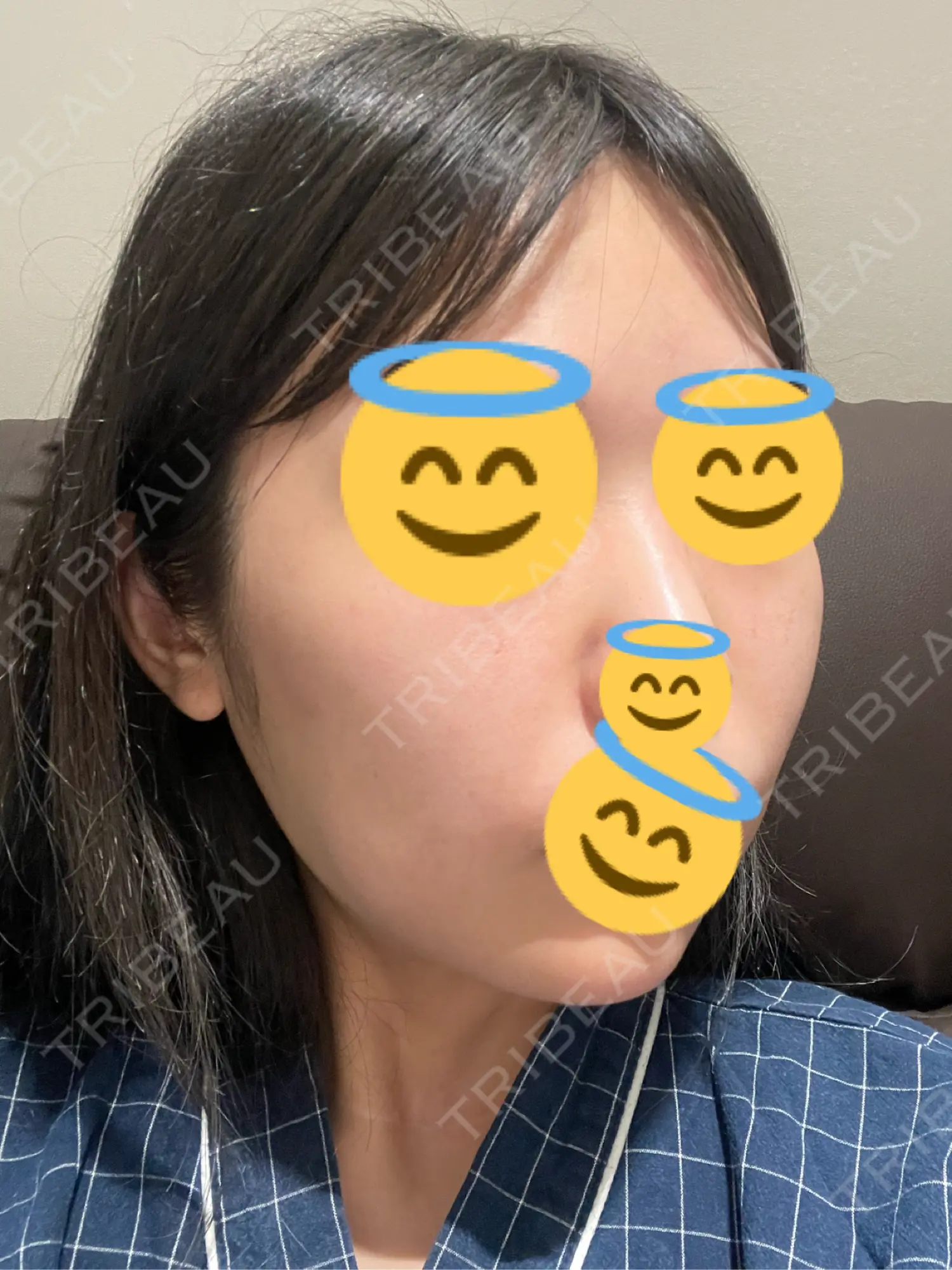 施術後の写真