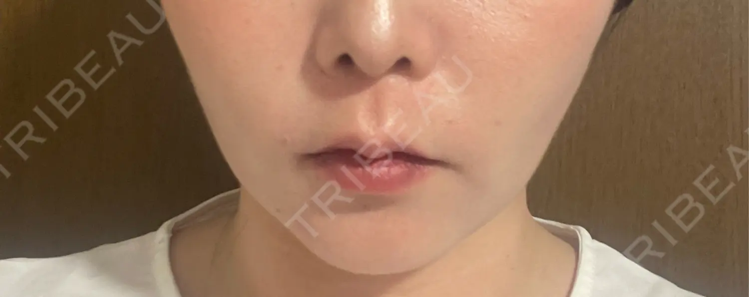 施術後の写真