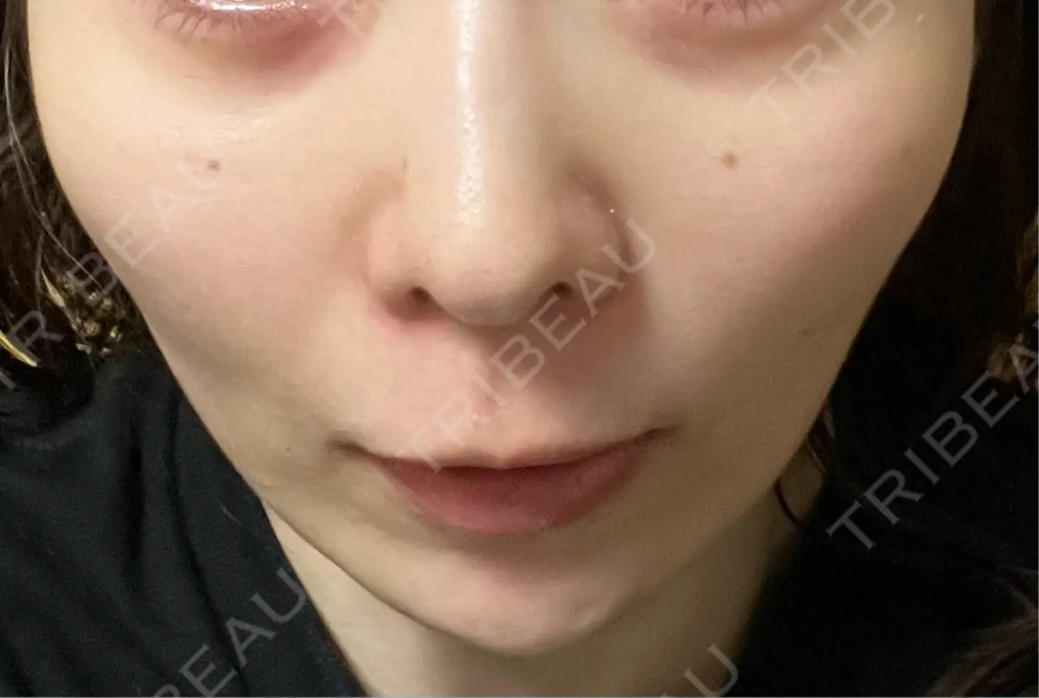 施術後の写真