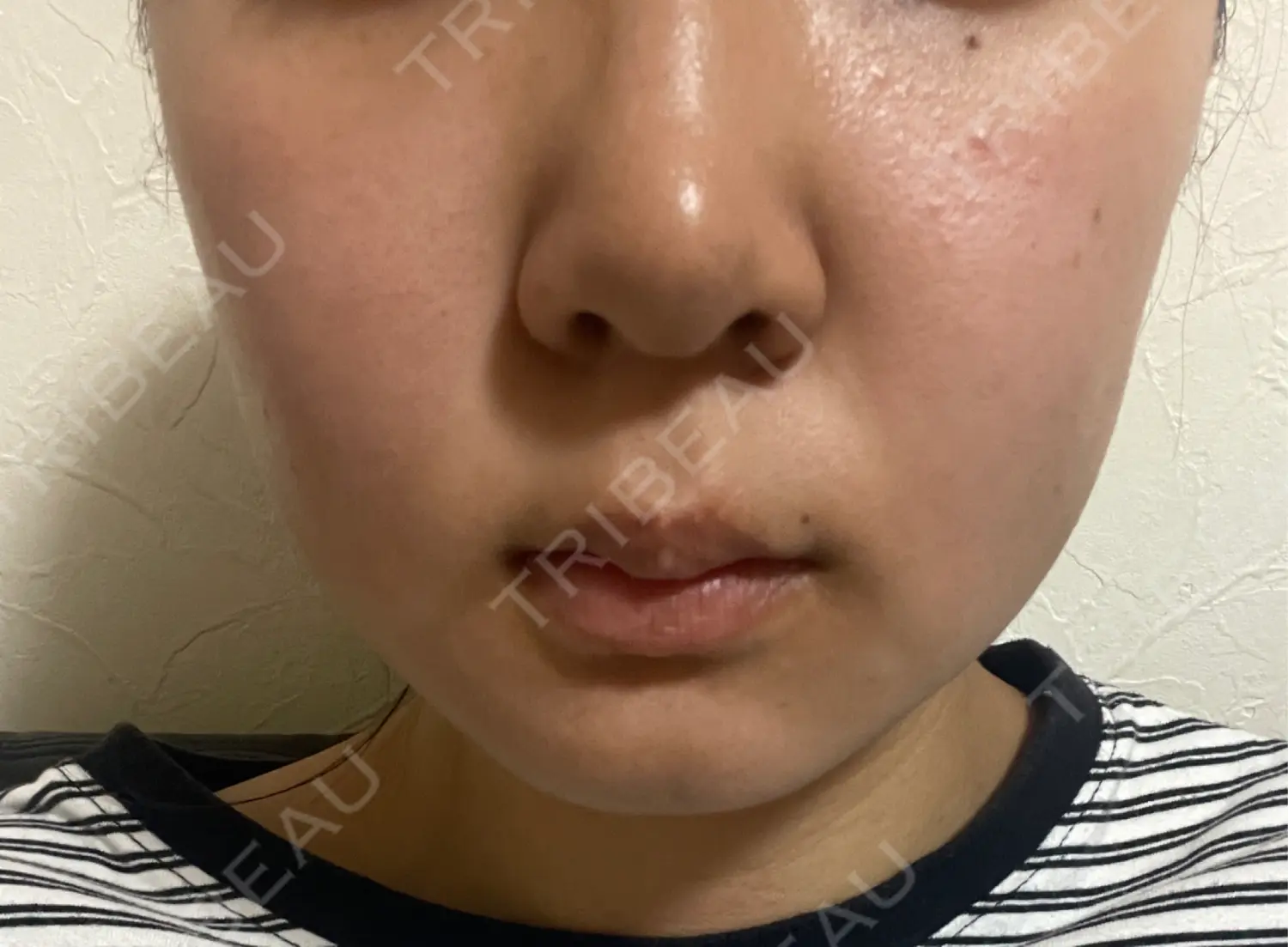 施術後の写真