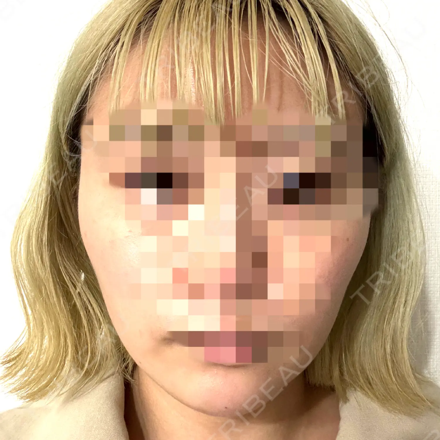 施術後の写真