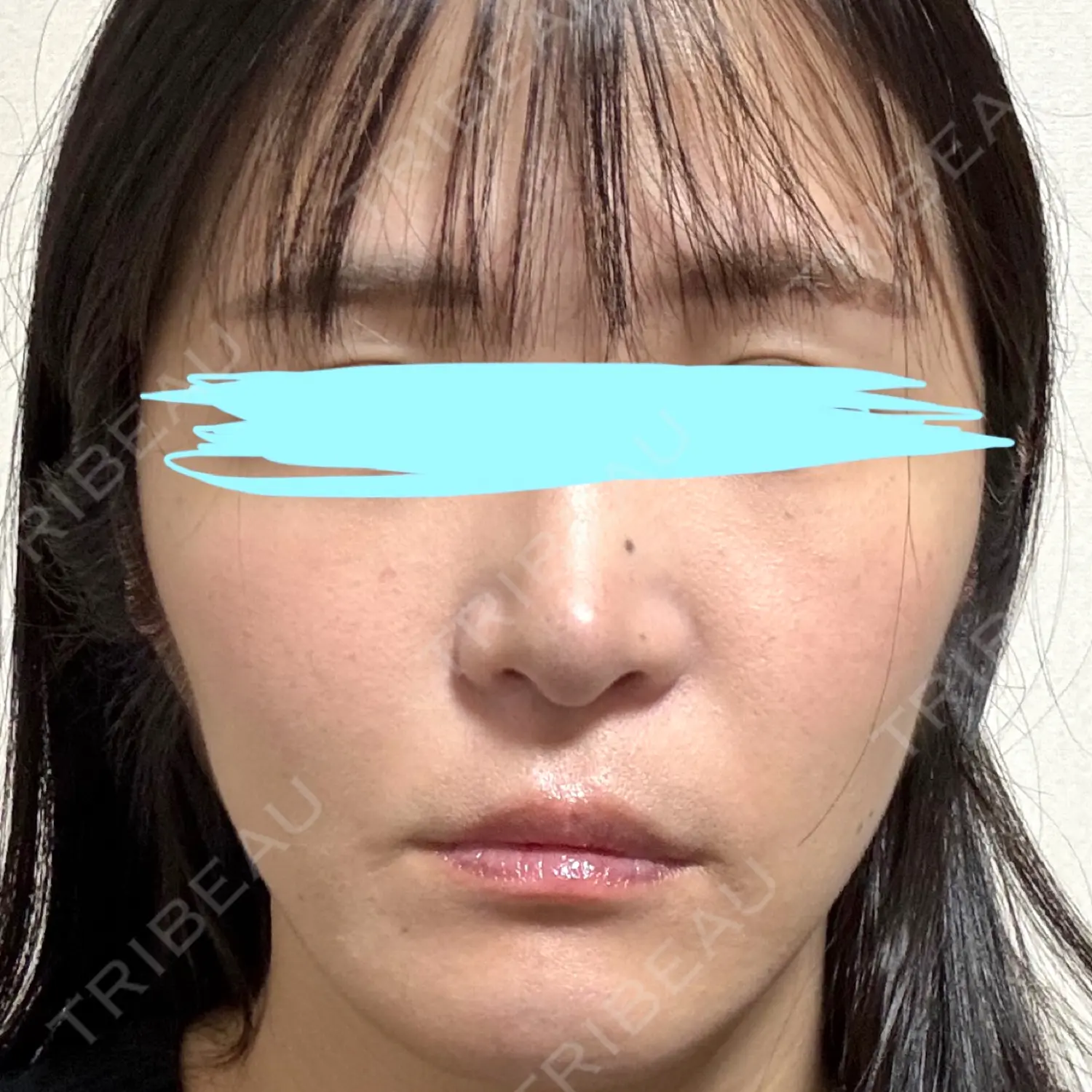 施術後の写真