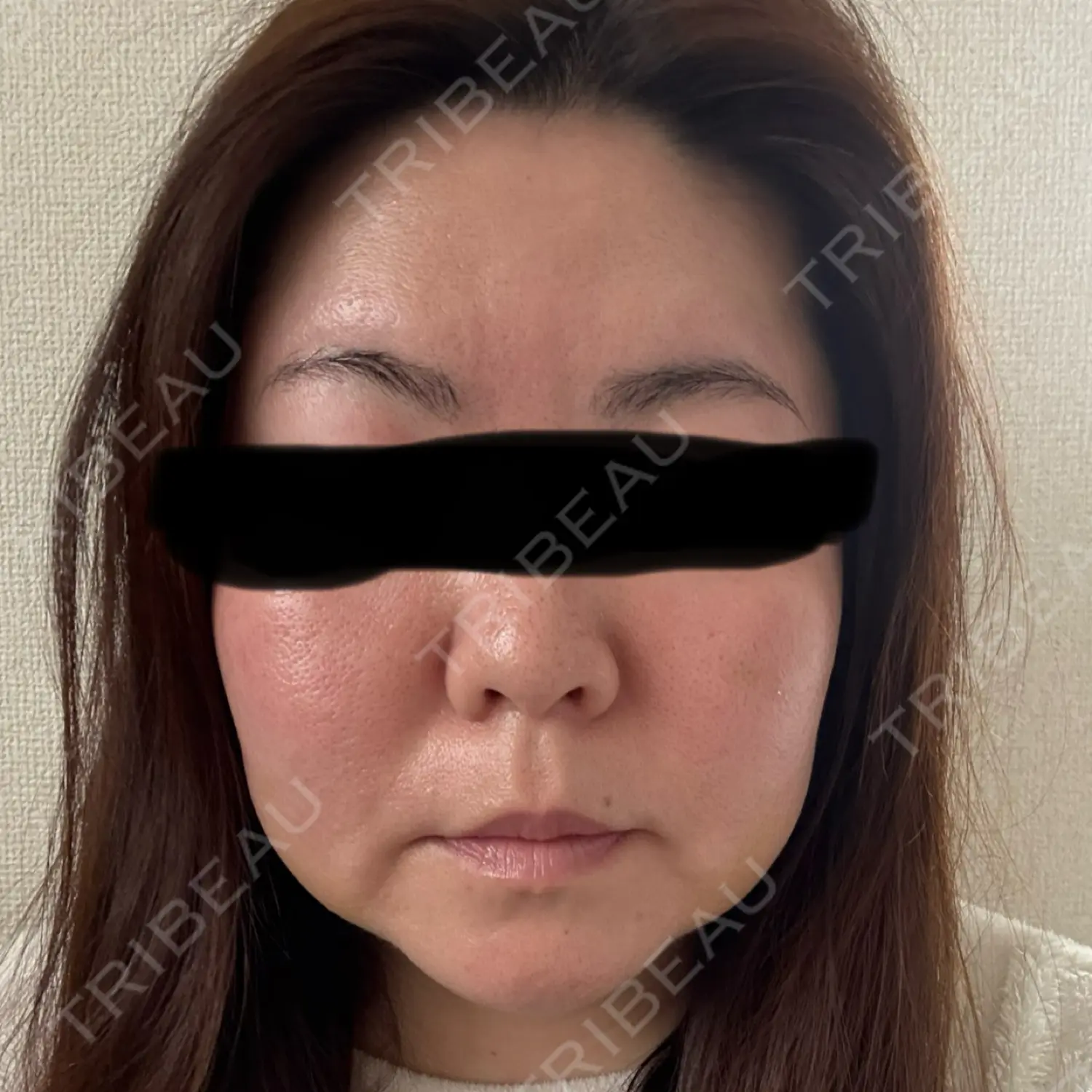 施術後の写真