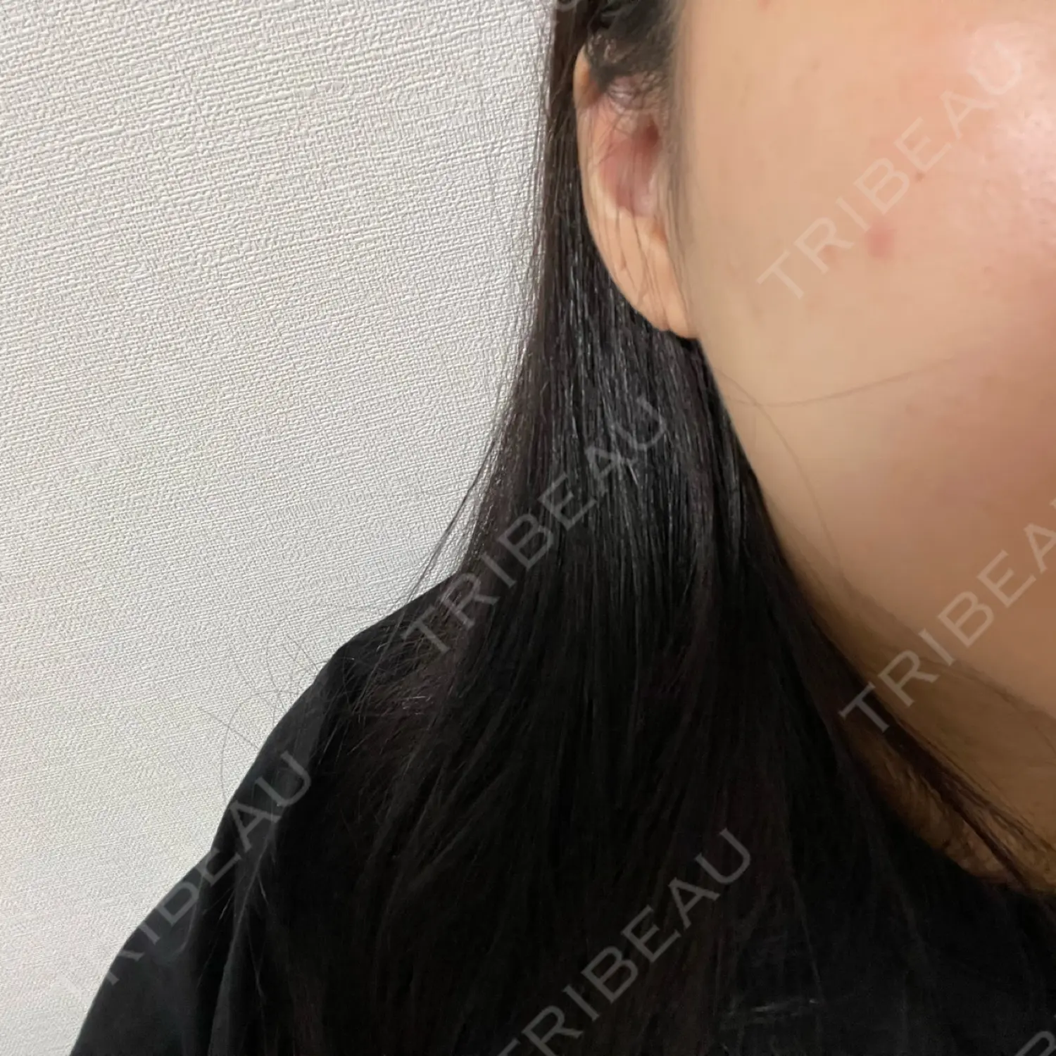 施術後の写真
