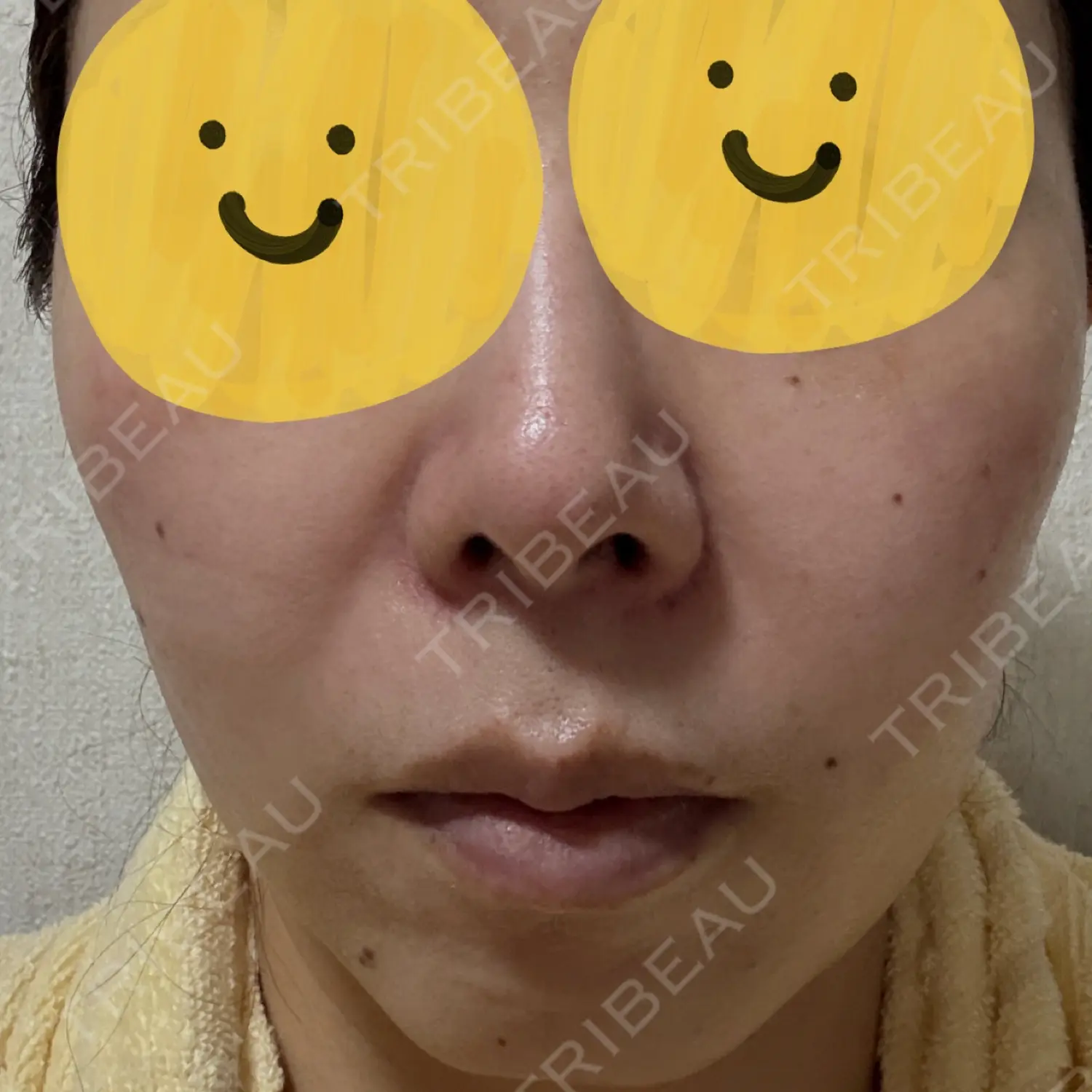 施術後の写真