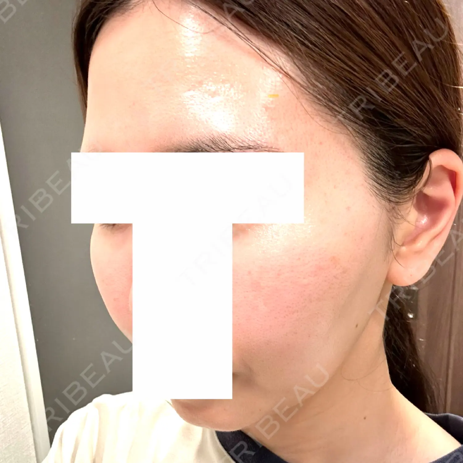 施術後の写真