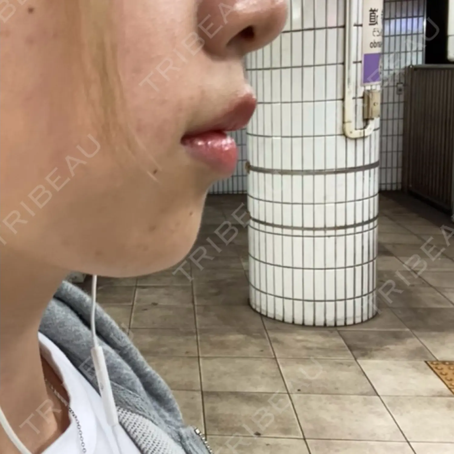 施術後の写真