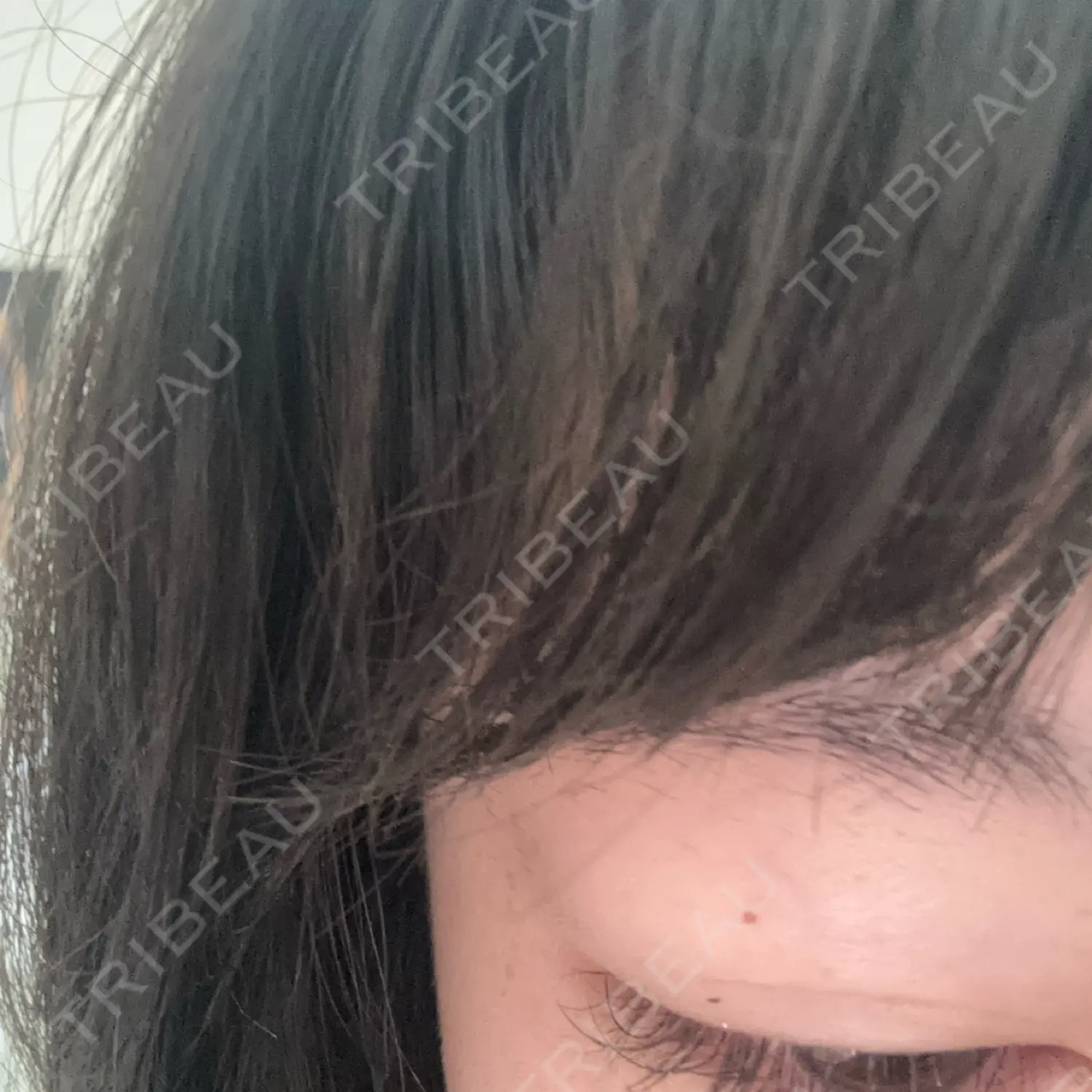 施術後の写真