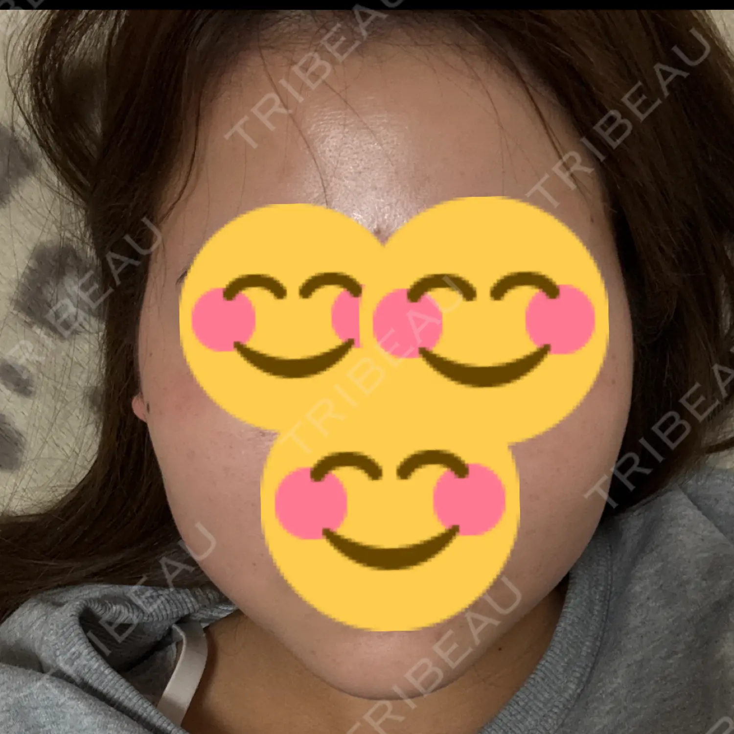 施術後の写真