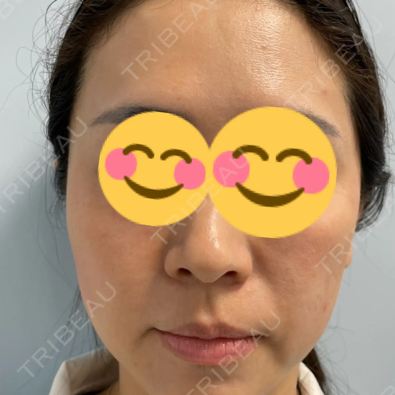 施術後の写真