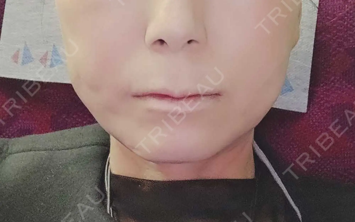 施術後の写真