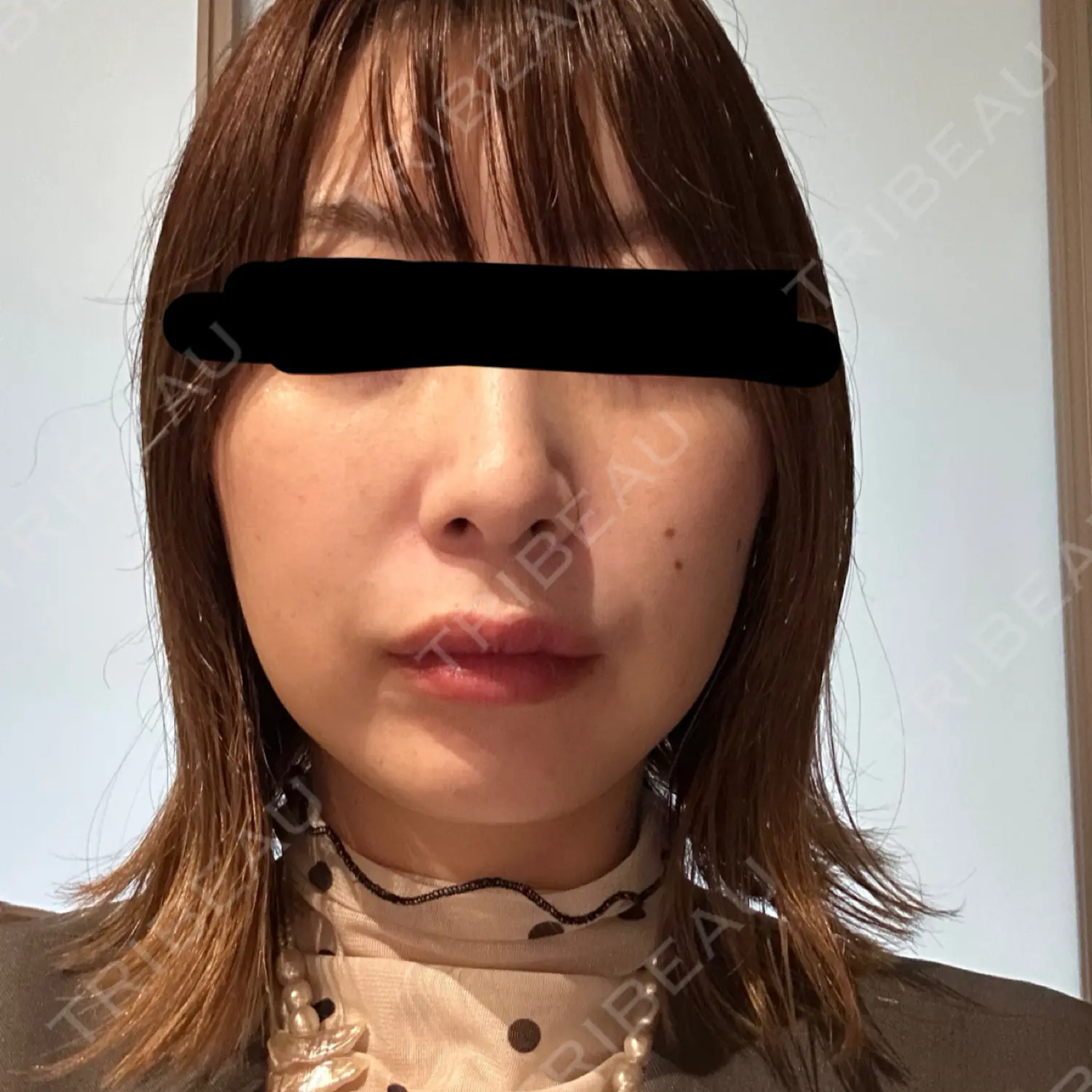 施術後の写真