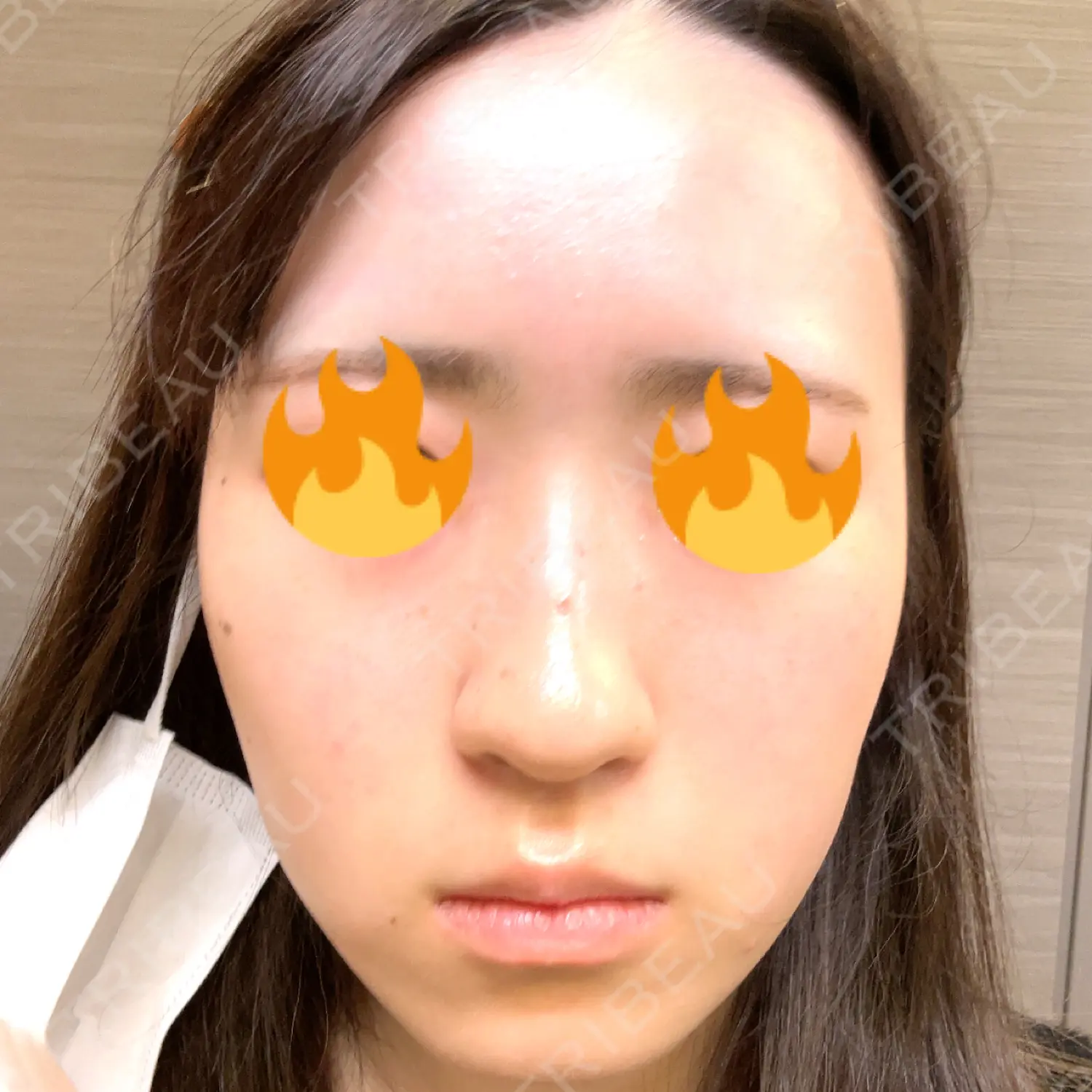 施術後の写真
