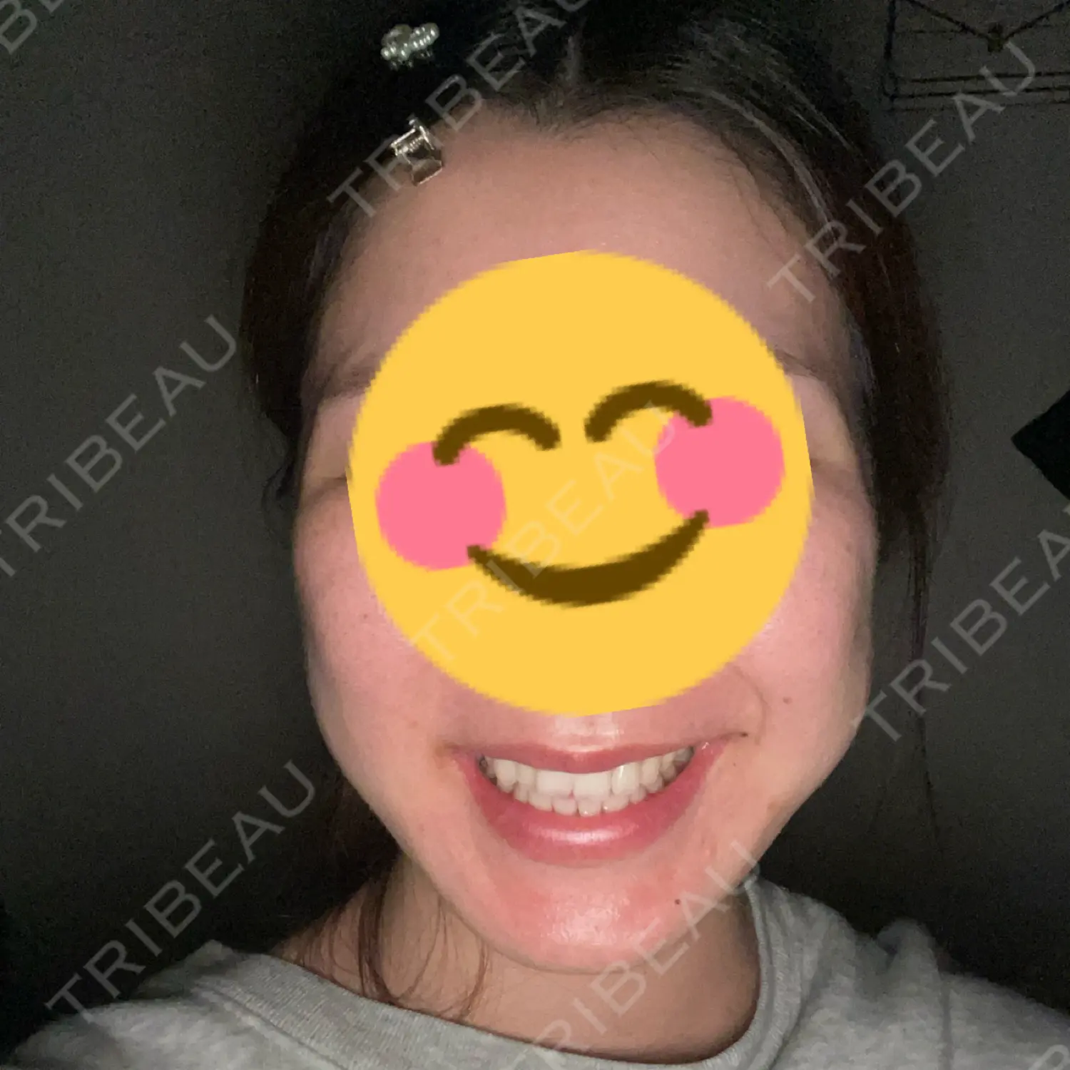 施術後の写真