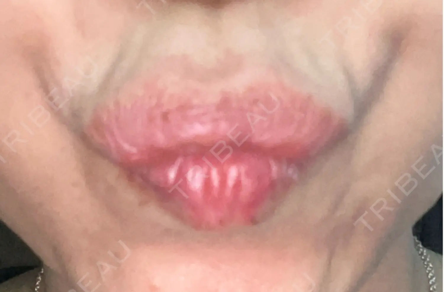 施術後の写真