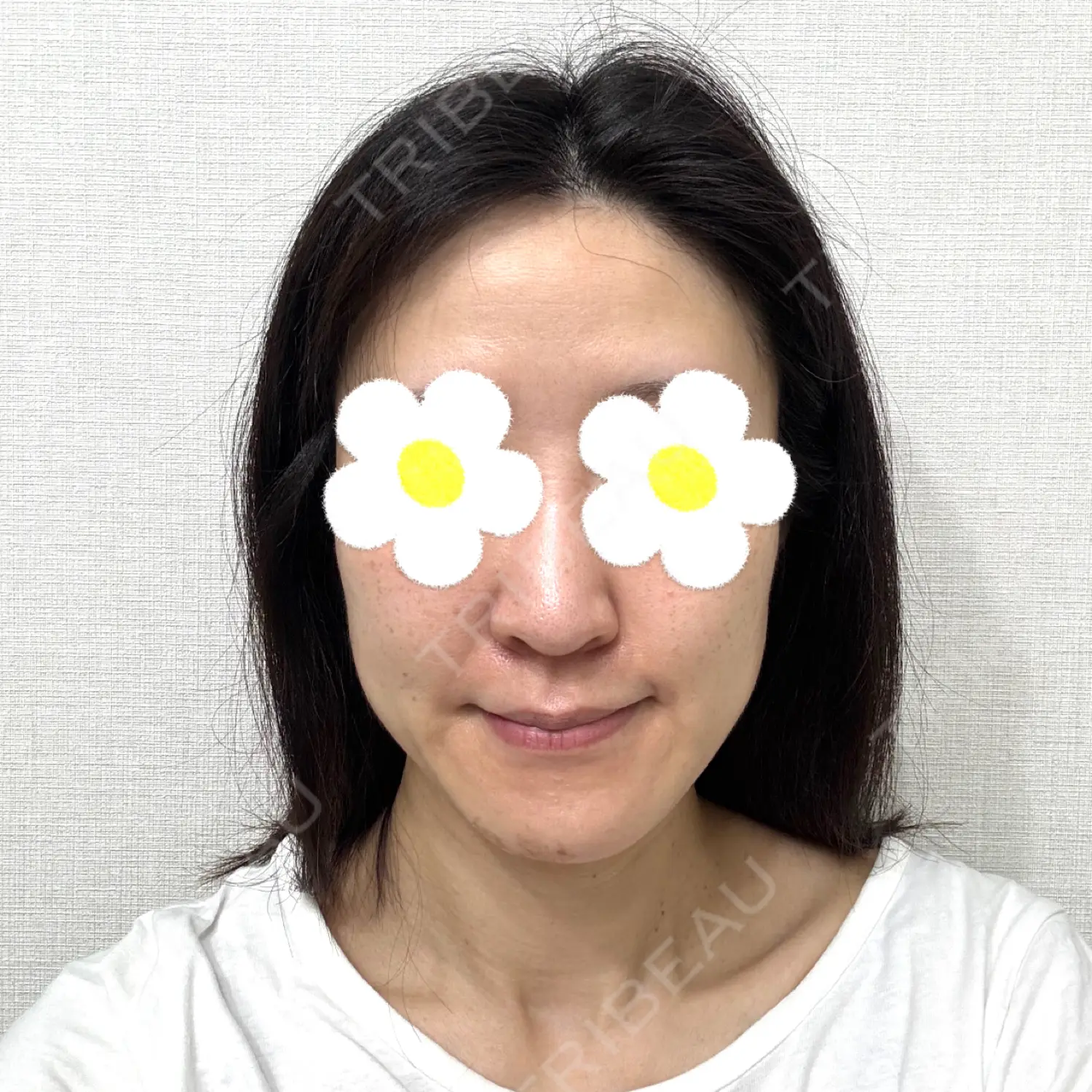 施術後の写真