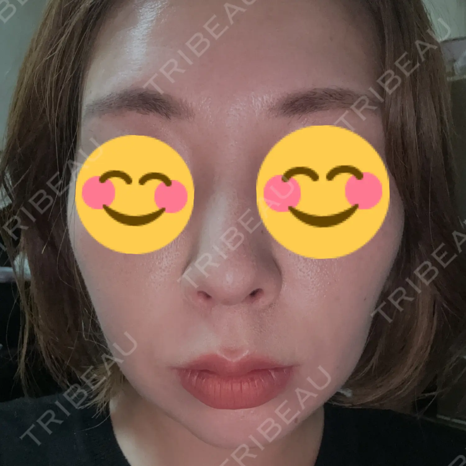 施術後の写真