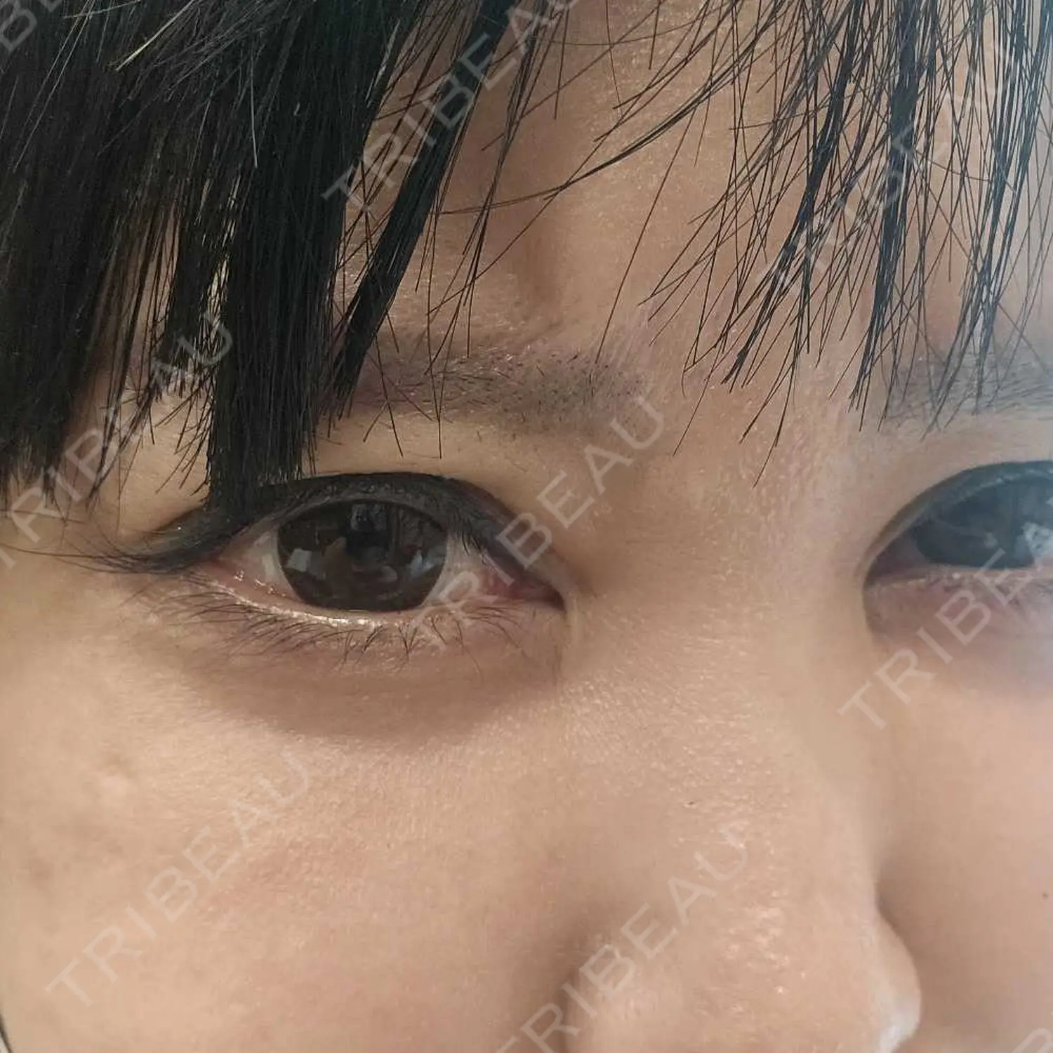 施術後の写真