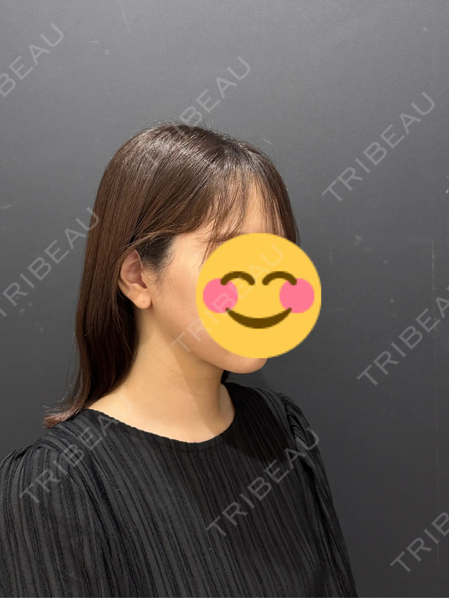 施術後の写真