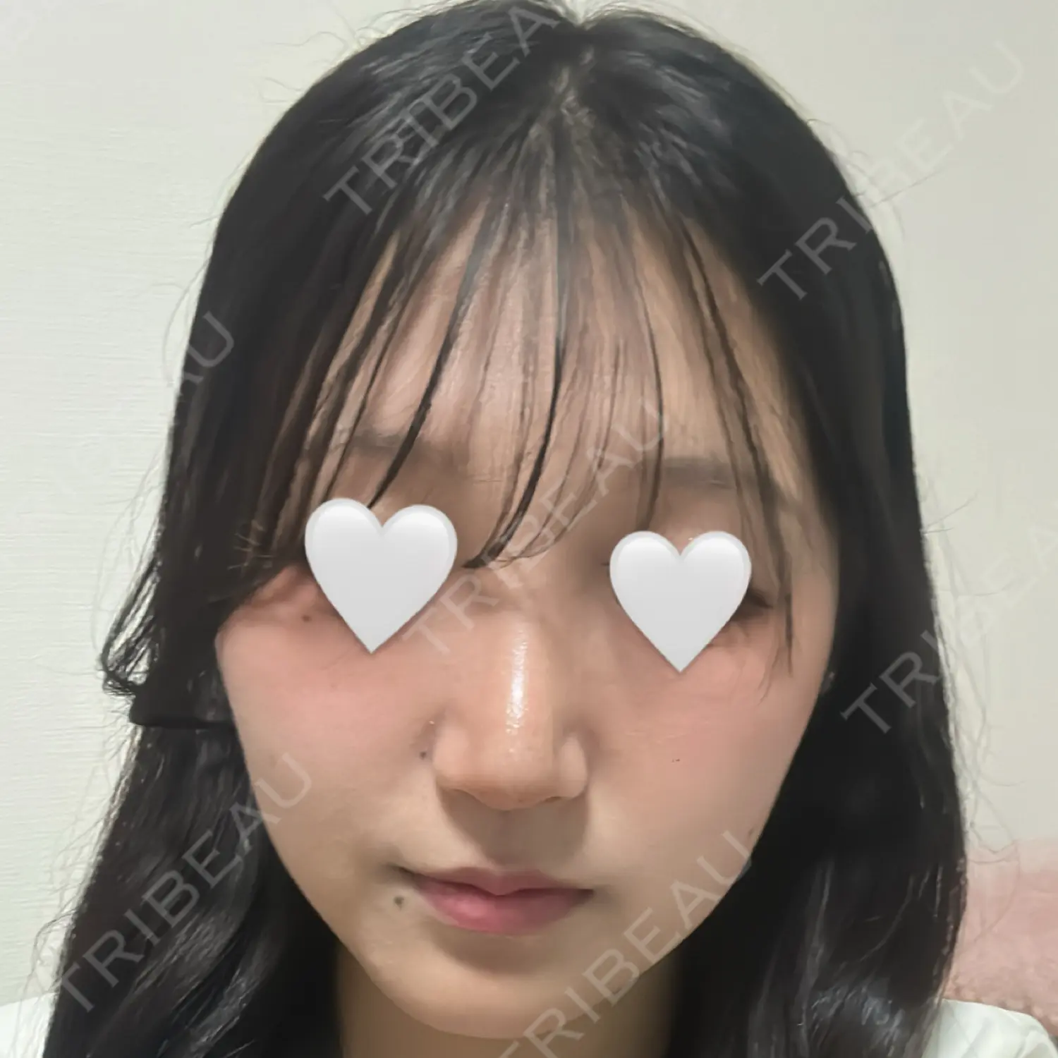 施術後の写真