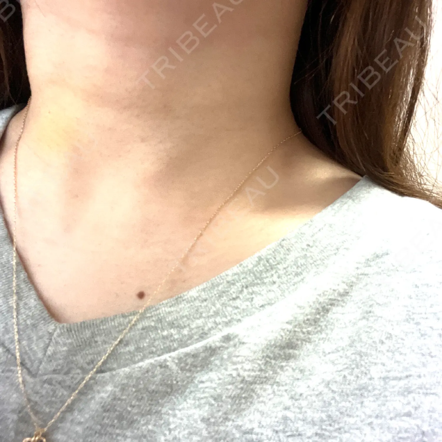 施術後の写真