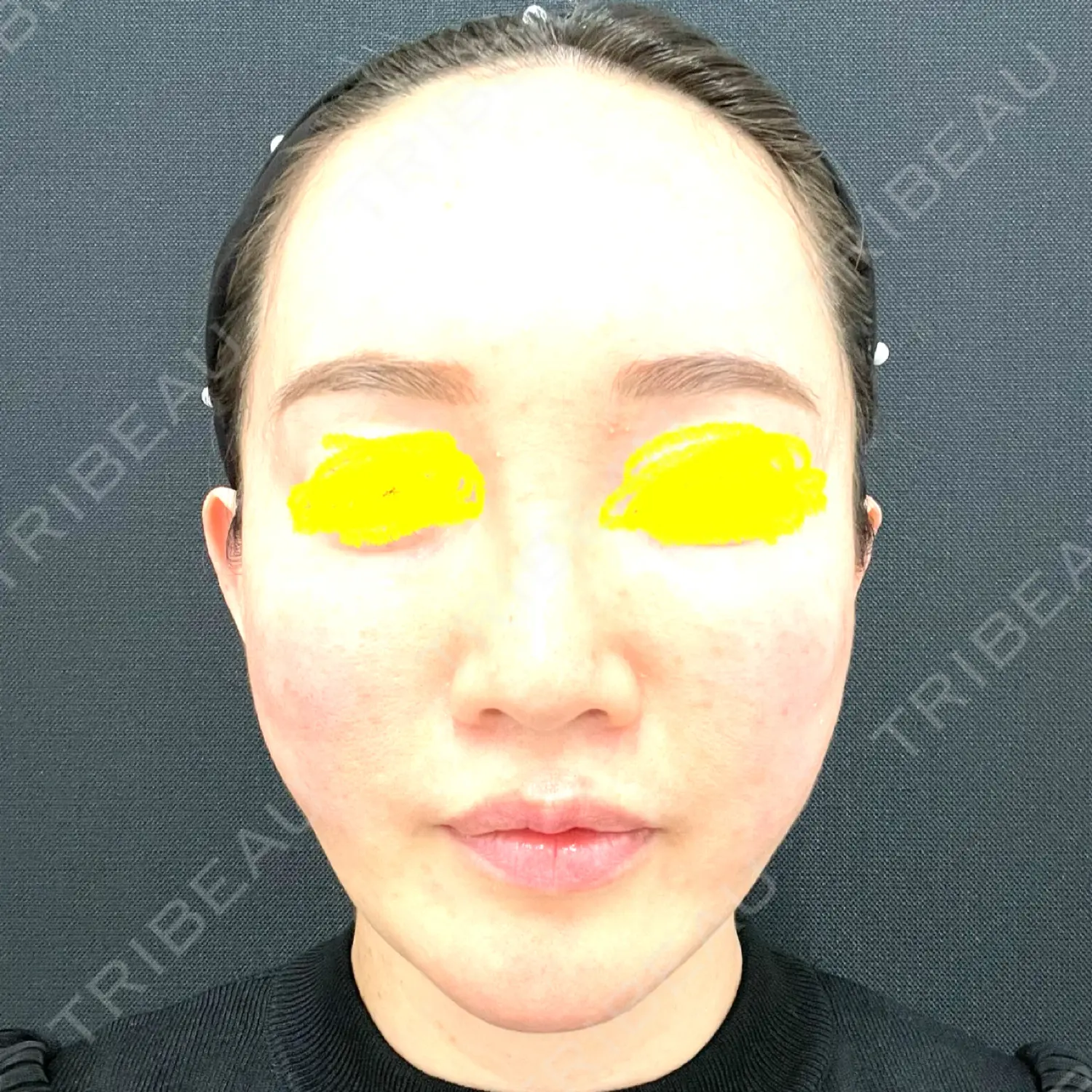 施術後の写真