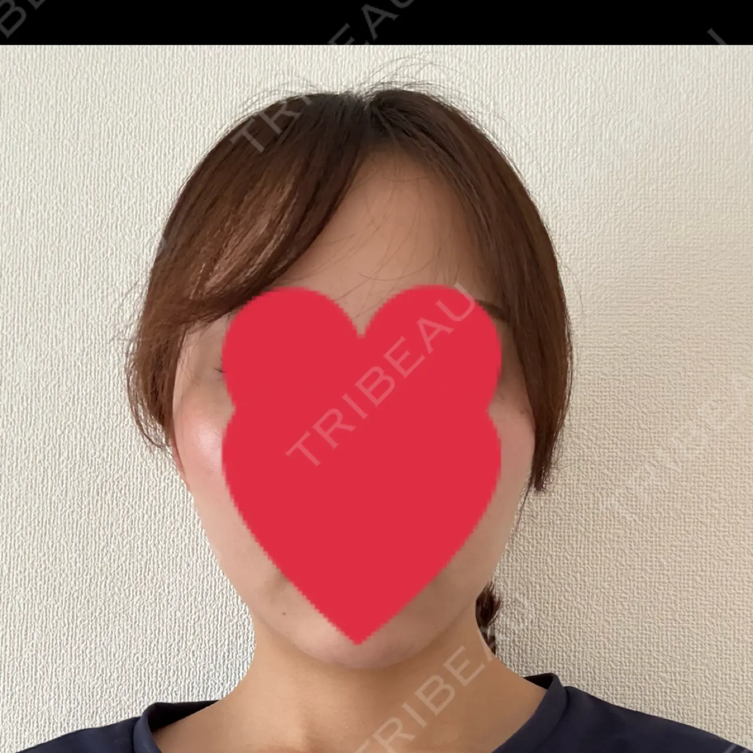 施術後の写真