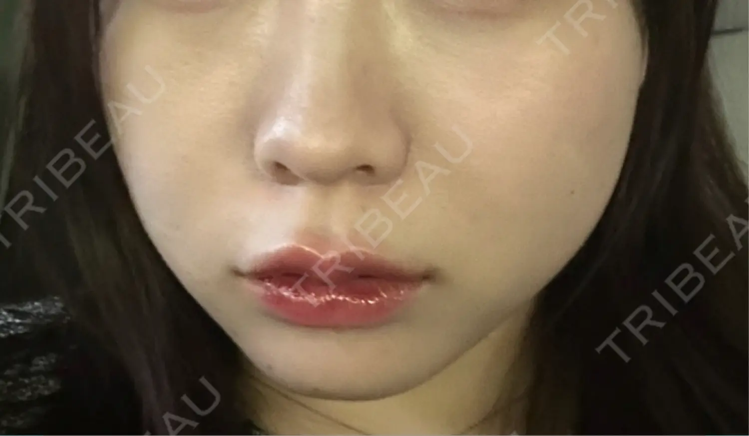 施術後の写真