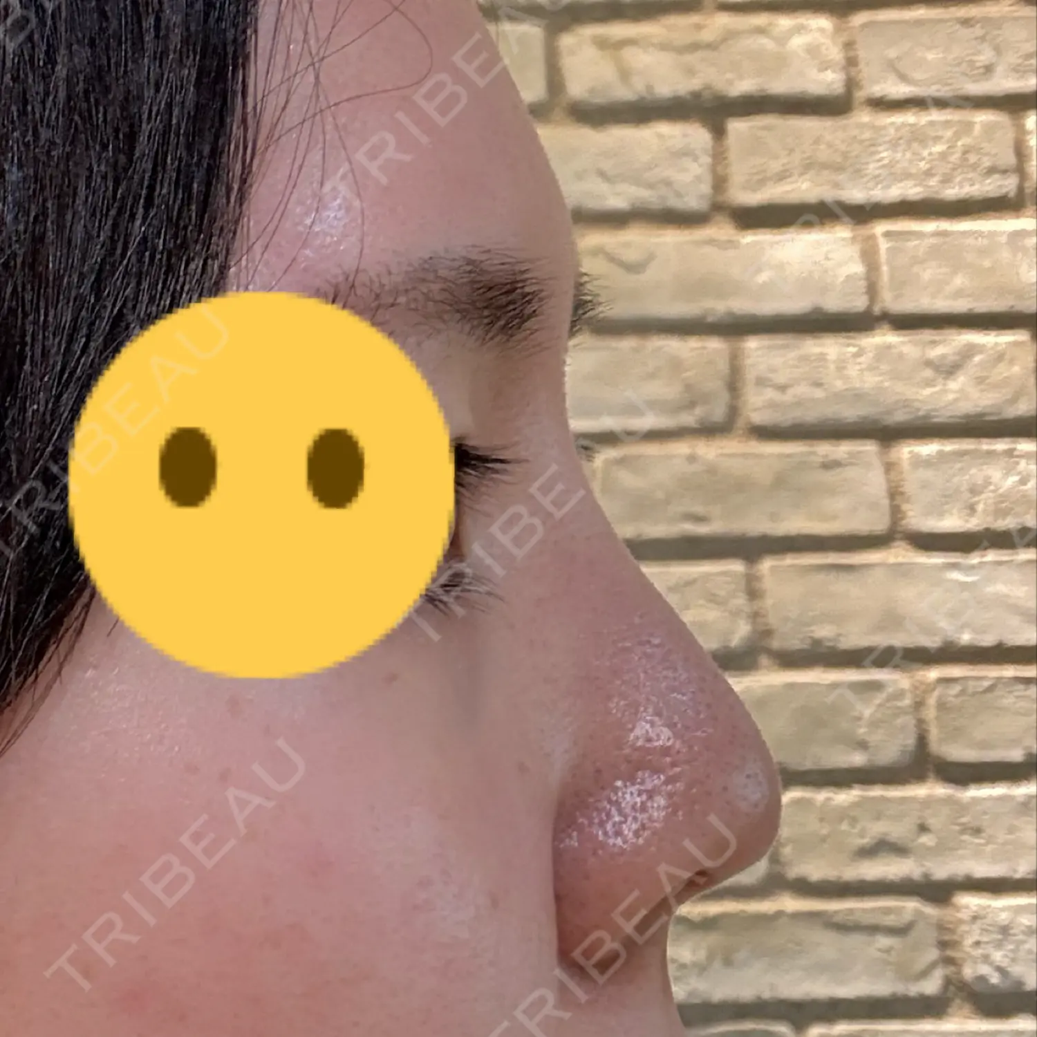 施術後の写真