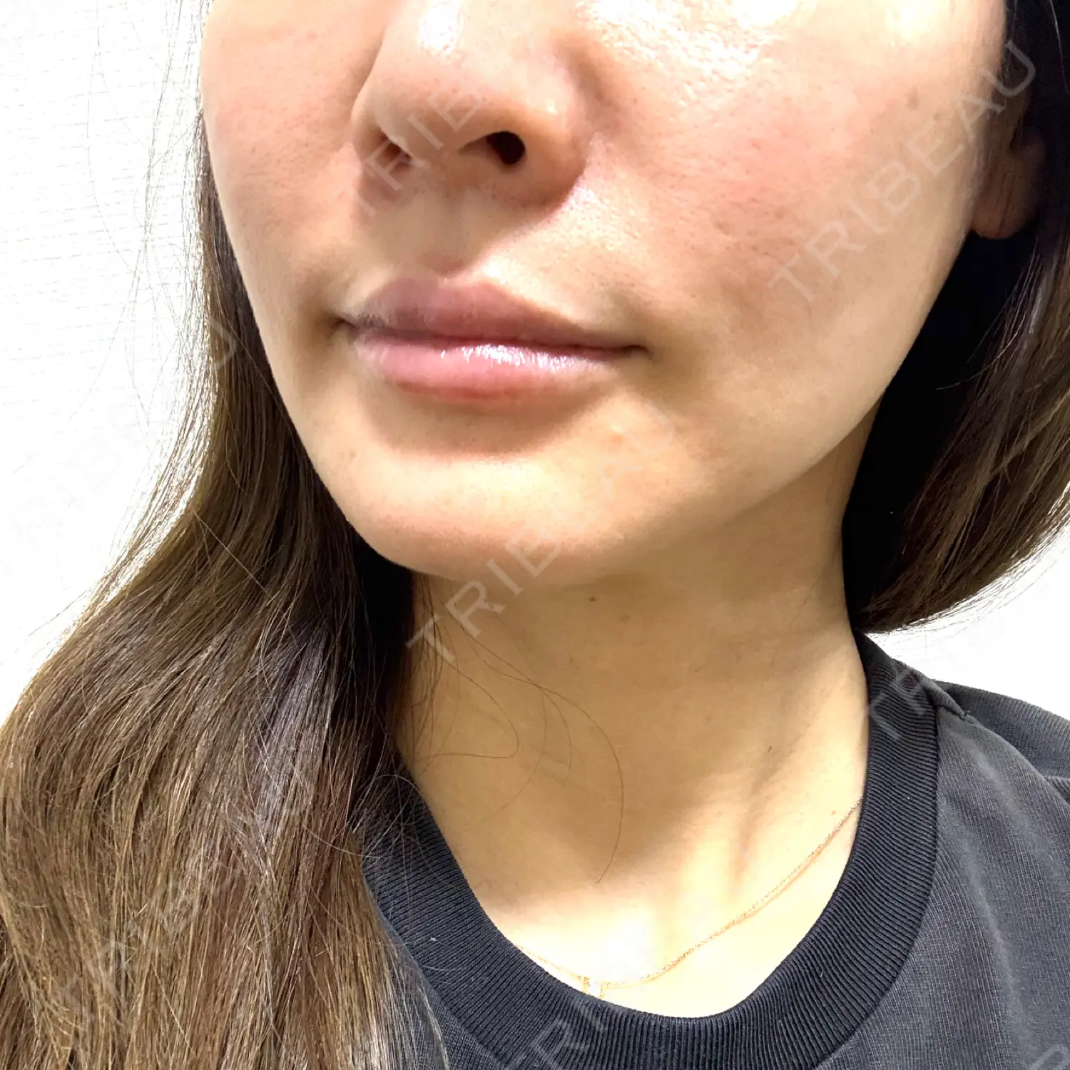 施術後の写真