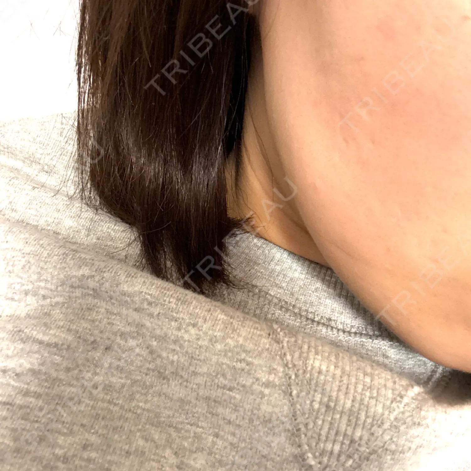 施術後の写真
