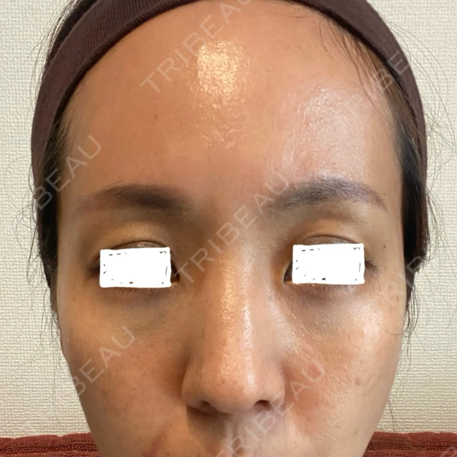 施術後の写真
