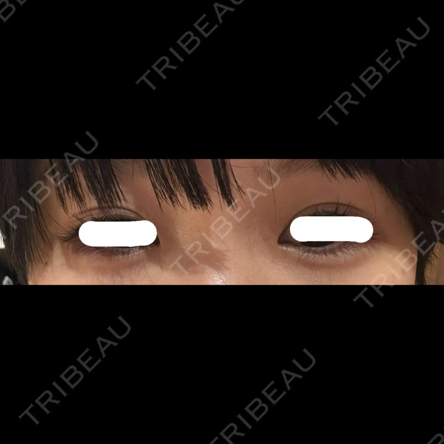 施術後の写真