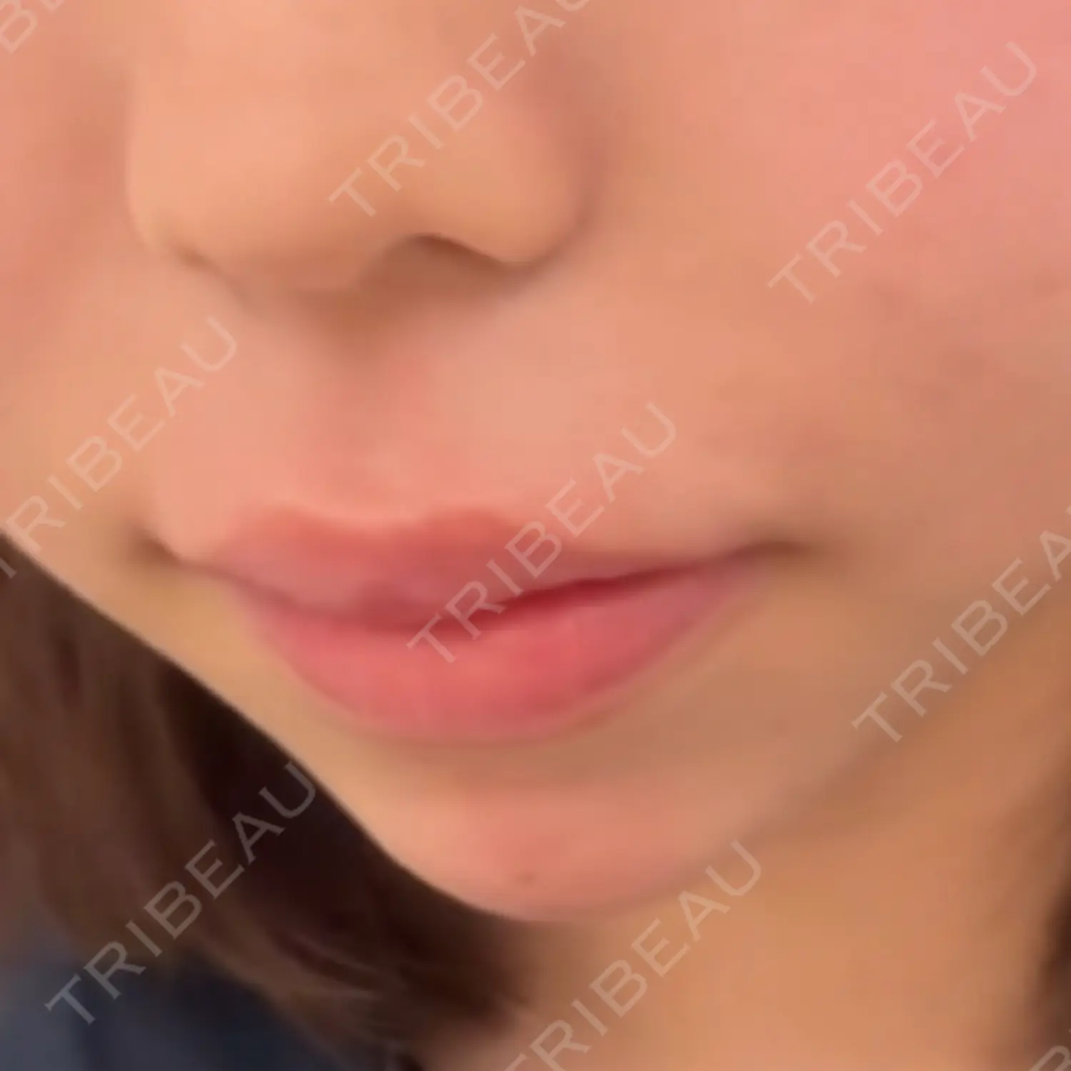 施術後の写真