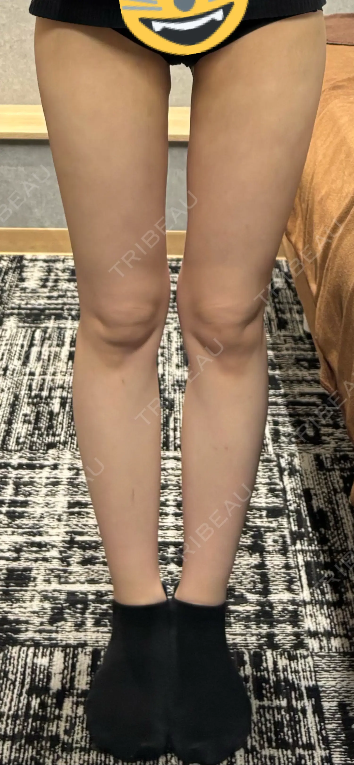 施術後の写真