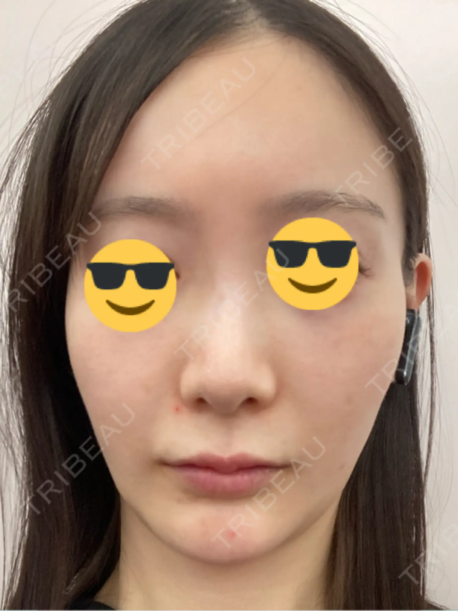 施術後の写真