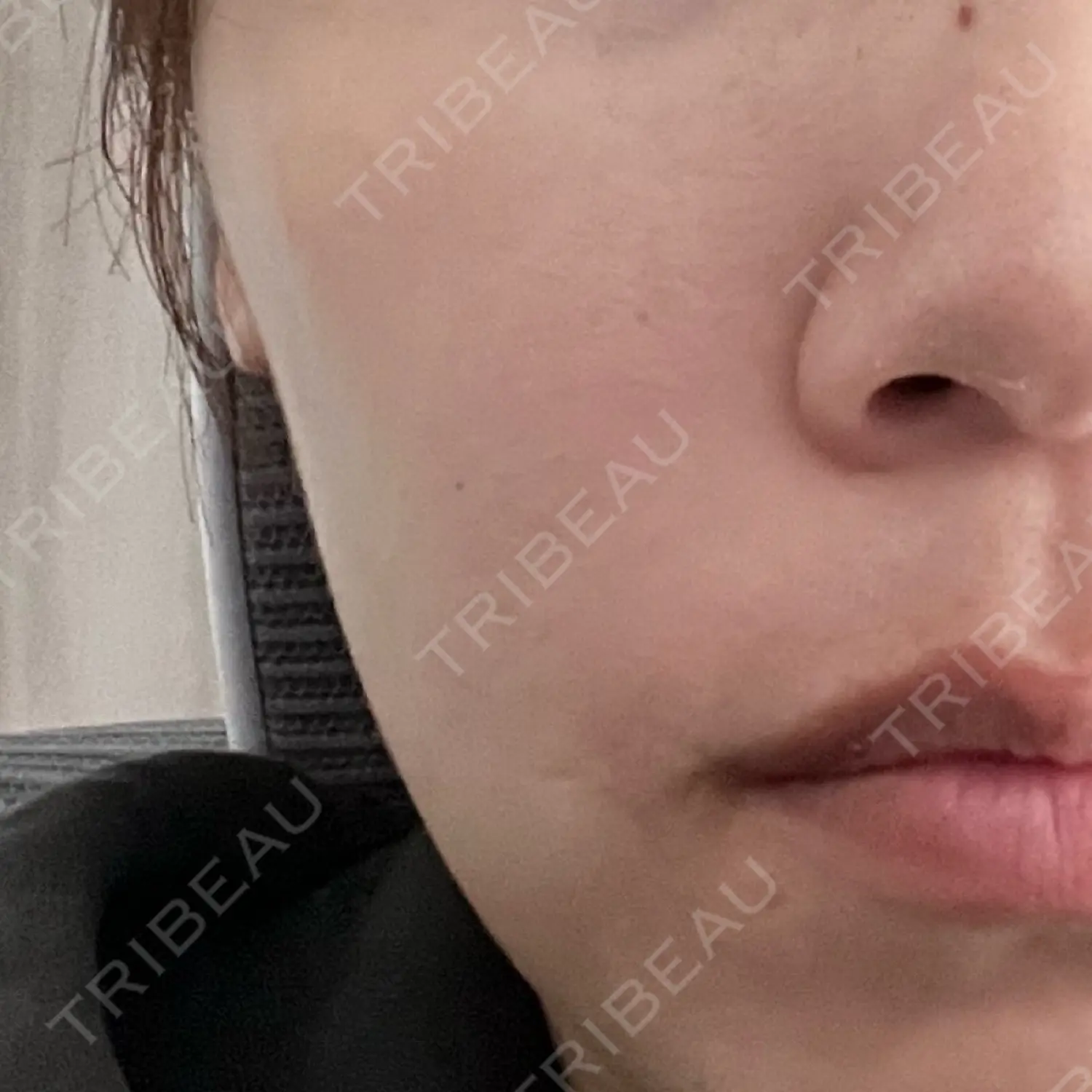 施術後の写真