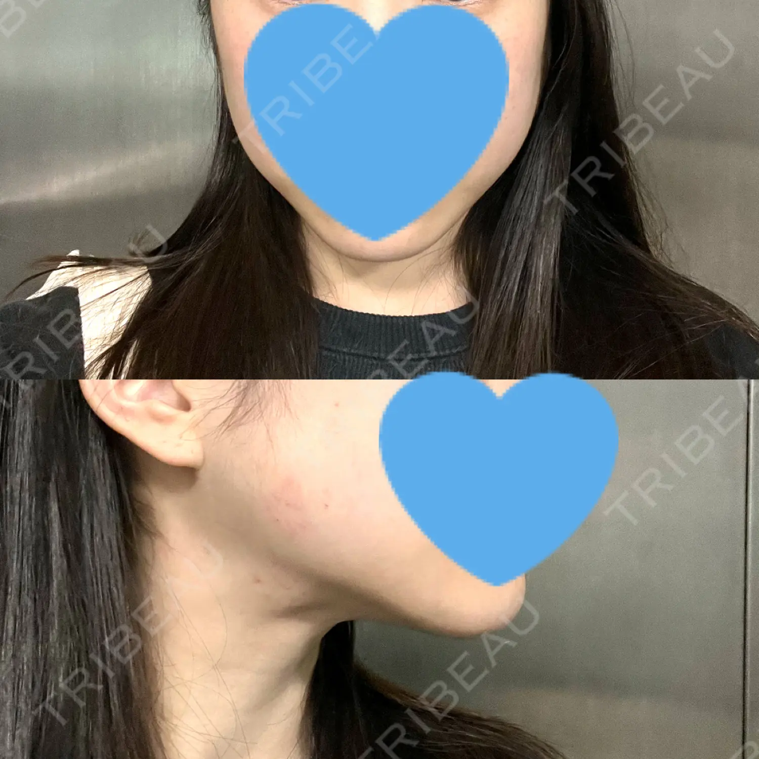 施術後の写真